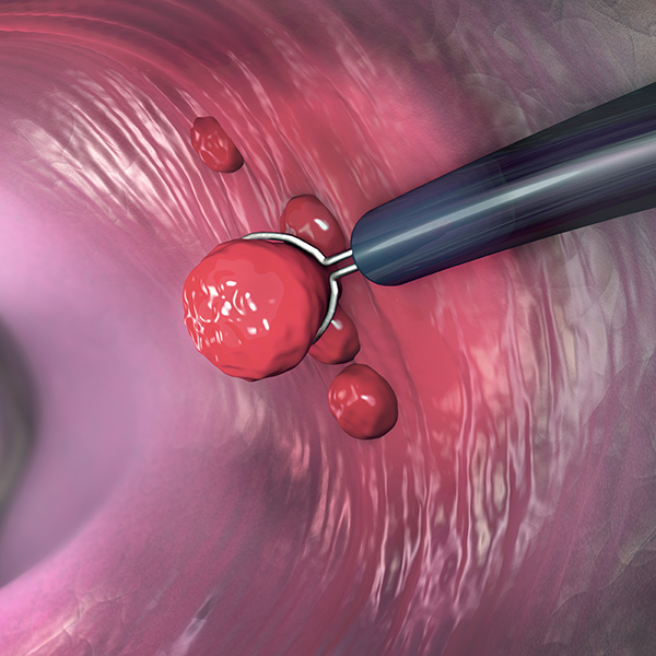 中野坂上米沢医院のポリープは検査中にその場で切除可能